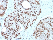 IHC staining of FFPE human prostate carcinoma with  NKX3.1 antibody (clone NKX3.1/3350). HIER: boil tissue sections in pH 9 10mM Tris with 1mM EDTA for 20 min and allow to cool before testing.