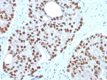 IHC staining of FFPE human prostate carcinoma with NKX3.1 antibody. HIER: boil tissue sections in pH 9 10mM Tris with 1mM EDTA for 20 min and allow to cool before testing.