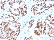 IHC staining of FFPE human prostate carcinoma with  NKX3.1 antibody (clone NKX3.1/3350). HIER: boil tissue sections in pH 9 10mM Tris with 1mM EDTA for 20 min and allow to cool before testing.