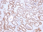 IHC staining of FFPE human prostate with  NKX3.1 antibody (clone NKX3.1/2836). HIER: boil tissue sections in pH 9 10mM Tris with 1mM EDTA for 20 min and allow to cool before testing.