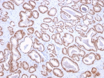 IHC staining of FFPE human prostate with NKX3.1 antibody. HIER: boil tissue sections in pH 9 10mM Tris with 1mM EDTA for 20 min and allow to cool before testing.