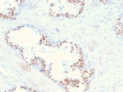 IHC staining of FFPE human prostate with  NKX3.1 antibody (clone NKX3.1/2836). HIER: boil tissue sections in pH 9 10mM Tris with 1mM EDTA for 20 min and allow to cool before testing.