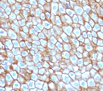 IHC staining of FFPE human esophageal carcinoma with DSG3 antibody (clone CFM6-1). HIER: boil tissue sections in pH 9 10mM Tris with 1mM EDTA for 10-20 min and allow to cool before testing.