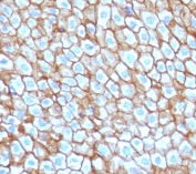 IHC staining of FFPE human esophageal carcinoma with DSG3 antibody (clone CFM6-1). HIER: boil tissue sections in pH 9 10mM Tris with 1mM EDTA for 10-20 min and allow to cool before testing.