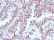 IHC staining of FFPE human colon carcinoma with NRF1 antibody (clone NRF1/2608). HIER: boil tissue sections in pH 9 10mM Tris with 1mM EDTA for 20 min and allow to cool before testing.