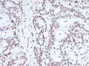 IHC staining of FFPE human prostate carcinoma with NRF1 antibody (clone NRF1/2609). HIER: boil tissue sections in pH 9 10mM Tris with 1mM EDTA for 20 min and allow to cool before testing.