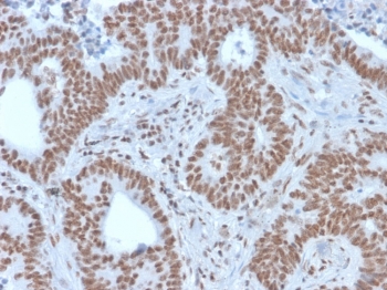 IHC staining of FFPE human colon carcinoma with NRF1 antibody. HIER: boil tissue sections in pH 9 10mM Tris with 1mM EDTA for 20 min and allow to cool before testing.