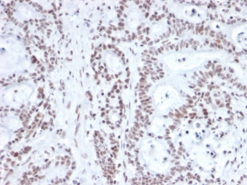 IHC staining of FFPE human prostate carcinoma with NRF1 antibody. HIER: boil tissue sections in pH 9 10mM Tris with 1mM EDTA for 20 min and allow to cool before testing.