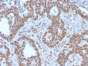 IHC staining of FFPE human colon carcinoma with NRF1 antibody (clone NRF1/2609). HIER: boil tissue sections in pH 9 10mM Tris with 1mM EDTA for 20 min and allow to cool before testing.