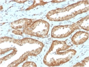 IHC staining of FFPE human prostate carcinoma with YB-1 antibody (clone YBX1/2430). HIER: boil tissue sections in pH 9 10mM Tris with 1mM EDTA for 20 min and allow to cool before testing.