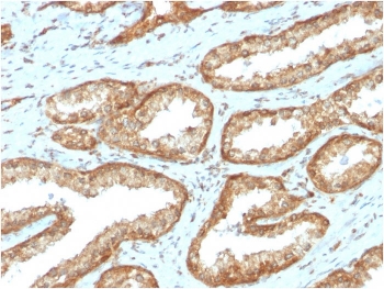 IHC staining of FFPE human prostate carcinoma with recombinant YB-1 antibody (clone rYBX1/2430). HIER: boil tissue sections in pH 9 10mM Tris with 1mM EDTA for 20 min and allow to cool before testing.~