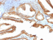 IHC staining of FFPE human prostate carcinoma with recombinant YB-1 antibody (clone rYBX1/2430). HIER: boil tissue sections in pH 9 10mM Tris with 1mM EDTA for 20 min and allow to cool before testing.