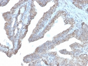 IHC staining of FFPE human prostate carcinoma with recombinant ODC1 antibody (clone rODC1/485). HIER: boil tissue sections in pH 9 10mM Tris with 1mM EDTA for 20 min and allow to cool before testing.