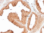 IHC staining of FFPE human prostate carcinoma with recombinant ODC1 antibody (clone ODC1/3636R). HIER: boil tissue sections in pH 9 10mM Tris with 1mM EDTA for 20 min and allow to cool before testing.