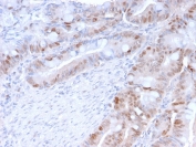 IHC staining of FFPE human colon carcinoma with PCNA antibody (clone PC5). HIER: boil tissue sections in pH 9 10mM Tris with 1mM EDTA for 20 min and allow to cool before testing.