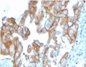 IHC staining of FFPE human colon carcinoma with MerTK  antibody (clone TPKR-1). HIER: boil tissue sections in pH 9 10mM Tris with 1mM EDTA for 10-20 min and allow to cool before testing.