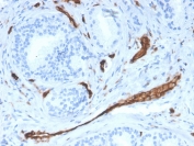 IHC staining of FFPE human prostate with CD31 antibody (clone PECAM1/3528). HIER: boil tissue sections in pH 9 10mM Tris with 1mM EDTA for 10-20 min and allow to cool before testing.