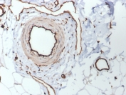 IHC staining of FFPE human skin with CD31 antibody (clone PECAM1/3530). HIER: boil tissue sections in pH 9 10mM Tris with 1mM EDTA for 10-20 min and allow to cool before testing.