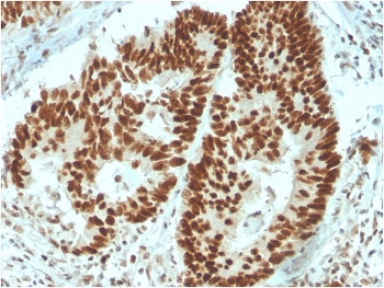 IHC staining of FFPE human colon carcinoma with MSH6 antibody (clone MSH6/3091). HIER: boil tissue sections in pH 9 10mM Tris with 1mM EDTA for 10-20 min and allow to cool before testing.