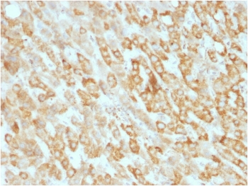 IHC testing of FFPE human hepatic carcinoma with Prohibitin antibody (clone SPM311). Required HIER: boil tissue sections in pH 9 10mM Tris with 1mM EDTA for 10-20 min followed by cooling at RT for 20 min.