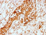 IHC staining of FFPE human breast with recombinant Alpha 1 Antitrypsin antibody (clone AAT/3167R). HIER: boil tissue sections in pH 9 10mM Tris with 1mM EDTA for 20 min and allow to cool before testing.