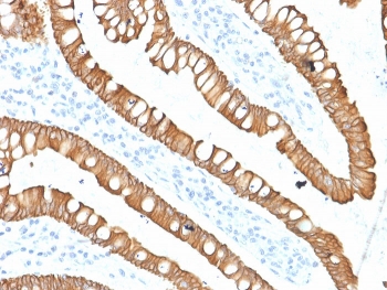 IHC staining of FFPE human colon carcinoma with Cytokeratin 20 antibody (clone SPM140). HIER: boil tissue sections in pH 9 10mM Tris with 1mM EDTA for 20 min and allow to cool before testing.