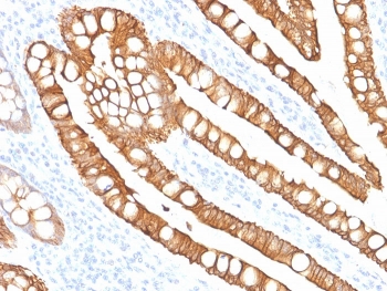 IHC staining of FFPE human colon carcinoma with Cytokeratin 20 antibody (clone SPM191). HIER: boil tissue sections in pH 9 10mM Tris with 1mM EDTA for 20 min and allow to cool before testing.