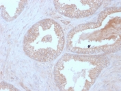IHC staining of FFPE human prostate carcinoma with PPP3R1 antibody (clone CALNB/2342). HIER: boil tissue sections in pH 9 10mM Tris with 1mM EDTA for 20 min and allow to cool before testing.
