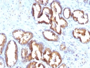 IHC staining of FFPE human prostate carcinoma with PSAP antibody (clone PASE/4LJ). HIER: boil tissue sections in pH 9 10mM Tris with 1mM EDTA for 20 min and allow to cool before testing.