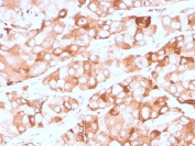 IHC staining of FFPE human breast carcinoma with recombinant Prolactin Receptor antibody (clone rPRLR/742). HIER: boil tissue sections in pH 9 10mM Tris with 1mM EDTA for 20 min and allow to cool before testing.