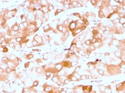 IHC staining of FFPE human breast carcinoma with recombinant Prolactin Receptor antibody (clone rPRLR/742). HIER: boil tissue sections in pH 9 10mM Tris with 1mM EDTA for 20 min and allow to cool before testing.