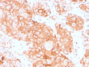 IHC staining of FFPE human testicular carcinoma with recombinant Prolactin Receptor antibody (clone PRLR/3785R). HIER: boil tissue sections in pH 9 10mM Tris with 1mM EDTA for 20 min and allow to cool before testing.~