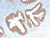 IHC staining of FFPE human prostate carcinoma with recombinant COX2 antibody. HIER: boil tissue sections in pH 9 10mM Tris with 1mM EDTA for 10-20 min and allow to cool before testing.