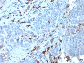 IHC staining of FFPE human tumor with recombinant IgM antibody (clone IGHM/3135R). HIER: boil tissue sections in pH 9 10mM Tris with 1mM EDTA for 10-20 min and allow to cool before testing.~