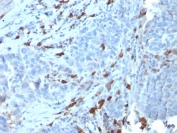 IHC staining of FFPE human tumor with recombinant IgM antibody (clone IGHM/3135R). HIER: boil tissue sections in pH 9 10mM Tris with 1mM EDTA for 10-20 min and allow to cool before testing.
