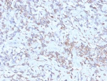 IHC: Formalin-fixed, paraffin-embedded human hepatocellular carcinoma stained with recombinant RBP-1 (clone rRBP/872). HIER: boil tissue sections in pH 9 10mM Tris with 1mM EDTA for 20 min and allow to cool before testing.~