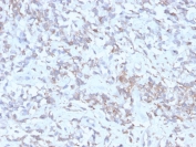 IHC: Formalin-fixed, paraffin-embedded human hepatocellular carcinoma stained with recombinant RBP-1 (clone rRBP/872). HIER: boil tissue sections in pH 9 10mM Tris with 1mM EDTA for 20 min and allow to cool before testing.
