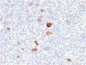 IHC staining of FFPE human Hodgkin's lymphoma with Bcl-X antibody (clone BCL2L1/2406). HIER: boil tissue sections in pH 9 10mM Tris with 1mM EDTA for 20 min and allow to cool before testing.