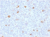 IHC staining of FFPE human Hodgkin's lymphoma with Bcl-X antibody (clone BCL2L1/2406). HIER: boil tissue sections in pH 9 10mM Tris with 1mM EDTA for 20 min and allow to cool before testing.