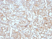 IHC testing of FFPE lung SCC with recombinant PD-L1 antibody (clone PDL1/4451R). HIER: boil tissue sections in pH 9 10mM Tris with 1mM EDTA for 10-20 min followed by cooling at RT for 20 min.