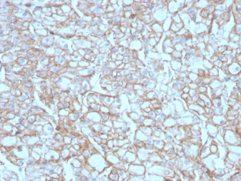 IHC testing of FFPE lung SCC with recombinant PD-L1 antibody (clone PDL1/4451R). HIER: boil tissue sections in pH 9 10mM Tris with 1mM EDTA for 10-20 min followed by cooling at RT for 20 min.~