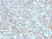 IHC testing of FFPE lung SCC with recombinant PD-L1 antibody (clone PDL1/4451R). HIER: boil tissue sections in pH 9 10mM Tris with 1mM EDTA for 10-20 min followed by cooling at RT for 20 min.
