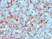 IHC staining of FFPE human melanoma with S100B antibody. HIER: boil tissue sections in pH 9 10mM Tris with 1mM EDTA for 20 min and allow to cool before testing.
