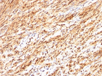 IHC staining of FFPE human schwanoma with S100B antibody. HIER: boil tissue sections in pH 9 10mM Tris with 1mM EDTA for 20 min and allow to cool before testing.~