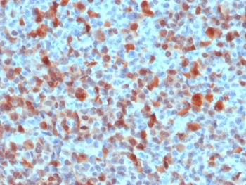 IHC staining of FFPE human melanoma with S100B antibody. HIER: boil tissue