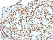 IHC staining of FFPE human breast carcinoma with BMI1 antibody (clone BMI1/2823). HIER: boil tissue sections in pH 9 10mM Tris with 1mM EDTA for 20 min and allow to cool before testing.