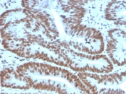 IHC staining of FFPE human colon carcinoma with BMI1 antibody (clone BMI1/2823). HIER: boil tissue sections in pH 9 10mM Tris with 1mM EDTA for 20 min and allow to cool before testing.