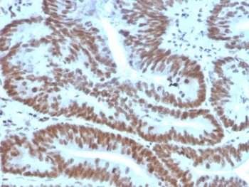 IHC staining of FFPE human colon carcinoma with BMI1 antibody. HIER: boil tissue sections in pH 9 10mM Tris with 1mM EDTA for 20 min and allow to cool before testing.