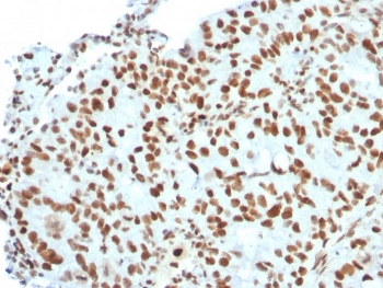IHC staining of FFPE human breast carcinoma with BMI1 antibody. HIER: boil tissue sections in pH 9 10mM Tris with 1mM EDTA for 20 min and allow to cool before testing.