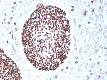 IHC staining of FFPE human cervix with recombinant SOX2 antibody (clone rSOX2/1791). HIER: boil tissue sections in pH 9 10mM Tris with 1mM EDTA for 10-20 min and allow to cool before testing.~
